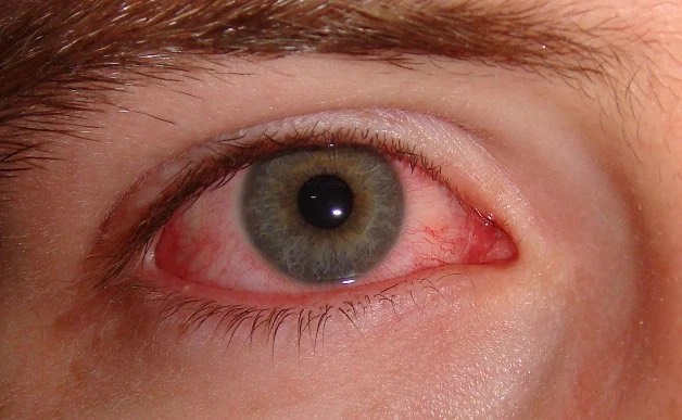Dân văn phòng có 5 thay đổi này ở mắt cần phải đi khám ngay vì đó là dấu hiệu của bệnh, thậm chí là ung thư - Ảnh 5